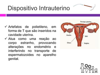 Dispositivo Intrauterino
 Artefatos de polietileno, em
forma de T que são inseridos na
cavidade uterina.
 Atua como uma reação ao
corpo estranho, provocando
alterações no endométrio e
interferindo no transporte de
espermatozoides no aparelho
genital.
 