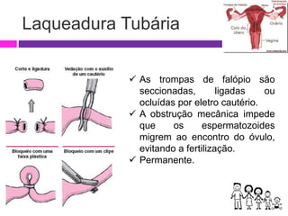 Laqueadura Tubária
 As trompas de falópio são
seccionadas, ligadas ou
ocluídas por eletro cautério.
 A obstrução mecânica impede
que os espermatozoides
migrem ao encontro do óvulo,
evitando a fertilização.
 Permanente.
 