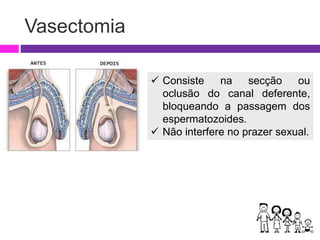 Vasectomia
 Consiste na secção ou
oclusão do canal deferente,
bloqueando a passagem dos
espermatozoides.
 Não interfere no prazer sexual.
 