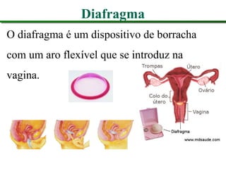 Diafragma
O diafragma é um dispositivo de borracha
com um aro flexível que se introduz na
vagina.
 