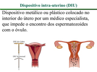 Dispositivo intra-uterino (DIU)
Dispositivo metálico ou plástico colocado no
interior do útero por um médico especialista,
que impede o encontro dos espermatozoides
com o óvulo.
 