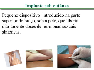 Implante sub-cutâneo
Pequeno dispositivo introduzido na parte
superior do braço, sob a pele, que liberta
diariamente doses de hormonas sexuais
sintéticas.
 