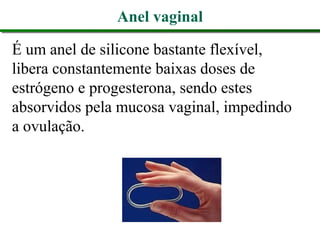 Anel vaginal
É um anel de silicone bastante flexível,
libera constantemente baixas doses de
estrógeno e progesterona, sendo estes
absorvidos pela mucosa vaginal, impedindo
a ovulação.
 