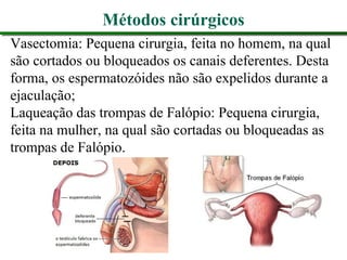 Métodos cirúrgicos
Vasectomia: Pequena cirurgia, feita no homem, na qual
são cortados ou bloqueados os canais deferentes. Desta
forma, os espermatozóides não são expelidos durante a
ejaculação;
Laqueação das trompas de Falópio: Pequena cirurgia,
feita na mulher, na qual são cortadas ou bloqueadas as
trompas de Falópio.
 