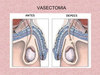 VASECTOMIA
 