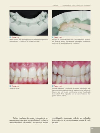 CAPÍTULO 7   •   PLANEJAMENTO ESTÉTICO EM DENTES ANTERIORES




■ Figura 7.15                                             ■ Figura 7.16
Matriz obtida pela moldagem do enceramento diagnóstico,   A matriz de silicone é preenchida com uma resina bis-acryl,
utilizada para a confecção do ensaio intra-oral.          que deve ser levada aos dentes e mantida em posição por
                                                          um tempo de aproximadamente 5 minutos.




■ Figura 7.17                                             ■ Figura 7.18
Situação inicial.                                         Situação logo após a confecção do ensaio diagnóstico, pre-
                                                          viamente aos procedimentos de acabamento e polimento.
                                                          Observe que este ensaio permite uma correta visualização
                                                          do resultado ﬁnal esperado, sem a necessidade de des-
                                                          gastes dentais prévios.




    Após a conclusão do ensaio restaurador é ne-          e modiﬁcações intra-orais poderão ser realizados
cessário que o paciente e o proﬁssional avaliem o         de acordo com as características e anseios de cada
resultado obtido e havendo a necessidade, ajustes         paciente.


                                                                                                                         145
 