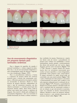 ODONTOLOGIA ESTÉTICA – Planejamento e técnica



      7.29                                                 7.30




      7.31                                                 7.32




      ■ Figuras 7.29 a 7.32
      Resultado ﬁnal obtido.




      Uso do enceramento diagnóstico                       face vestibular da mesma. Posiciona-se a matriz
                                                           nos dentes antes de iniciar o procedimento de
      em preparos dentais para                             preparo para veriﬁcar sua estabilidade e correto
      laminados cerâmicos                                  assentamento, porém quando o posicionamento
                                                           dos dentes não permitir que isto ocorra, alguns
           Para o desgaste da superfície do esmalte é      desgastes prévios serão necessários (Figuras 7.33
      essencial restabelecer o volume original do dente.   a 7.35). Durante o preparo dental esta mesma
      Para isto, o uso de um enceramento diagnóstico e     matriz deve ser novamente posicionada para
      uma correspondente matriz de silicone é imperati-    avaliar os locais especíﬁcos a serem desgastados,
      vo a esta consideração (Magne, 1999).                permitindo assim preparos mais conservadores.
           Para os procedimentos indiretos, a forma        O espaço necessário na região incisal pode ser
      e a espessura do preparo dental são variáveis        controlado com uma matriz palatal (Figura 7.36)
      possíveis para o sucesso das restaurações cerâ-      e após a ﬁnalização de todo preparo é necessário
      micas e diferentes geometrias de preparos podem      o posicionamento da matriz para veriﬁcar se há
      ser encontradas na literatura. Dentre as várias      uma espessura adequada para a confecção da res-
      técnicas de preparo descritas, independente do       tauração (Figura 7.37). Portanto, a quantidade de
      autor e tipo de tratamento proposto, um dos          desgaste da estrutura dental é calculada tendo em
      objetivos principais é a máxima preservação das      vista o resultado ﬁnal da restauração cerâmica e
      estruturas dentais sadias, desta forma, pode-se      não em relação ao que está presente no paciente,
      utilizar uma matriz para nortear a espessura de      como era realizado na técnica convencional da
      desgaste. Esta matriz é obtida pela moldagem do      silhueta. Resulta-se assim em preparos minima-
      enceramento diagnóstico e deve ser recortada no      mente invasivos e com máxima preservação da
      sentido horizontal, de forma a utilizar somente a    estrutura dental sadia (Figura 7.38).

150
 