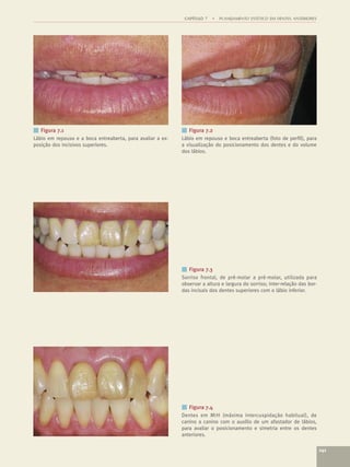 CAPÍTULO 7   •   PLANEJAMENTO ESTÉTICO EM DENTES ANTERIORES




■ Figura 7.1                                                ■ Figura 7.2
Lábio em repouso e a boca entreaberta, para avaliar a ex-   Lábio em repouso e boca entreaberta (foto de perﬁl), para
posição dos incisivos superiores.                           a visualização do posicionamento dos dentes e do volume
                                                            dos lábios.




                                                            ■ Figura 7.3
                                                            Sorriso frontal, de pré-molar a pré-molar, utilizada para
                                                            observar a altura e largura do sorriso; inter-relação das bor-
                                                            das incisais dos dentes superiores com o lábio inferior.




                                                            ■ Figura 7.4
                                                            Dentes em MIH (máxima intercuspidação habitual), de
                                                            canino a canino com o auxílio de um afastador de lábios,
                                                            para avaliar o posicionamento e simetria entre os dentes
                                                            anteriores.

                                                                                                                             141
 