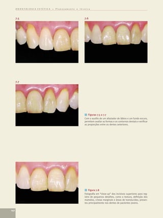 ODONTOLOGIA ESTÉTICA – Planejamento e técnica



      7.5                                      7.6




      7.7




                                               ■ Figuras 7.5 a 7.7
                                               Com o auxílio de um afastador de lábios e um fundo escuro,
                                               permitem avaliar as formas e os contornos dentais e veriﬁcar
                                               as proporções entre os dentes anteriores.




                                               ■ Figura 7.8
                                               Fotograﬁa em “close-up” dos incisivos superiores para reg-
                                               istro de pequenos detalhes, como a textura, deﬁnição dos
                                               mamelos, cristas marginais e áreas de translucidez, presen-
                                               tes principalmente nos dentes de pacientes jovens.


142
 