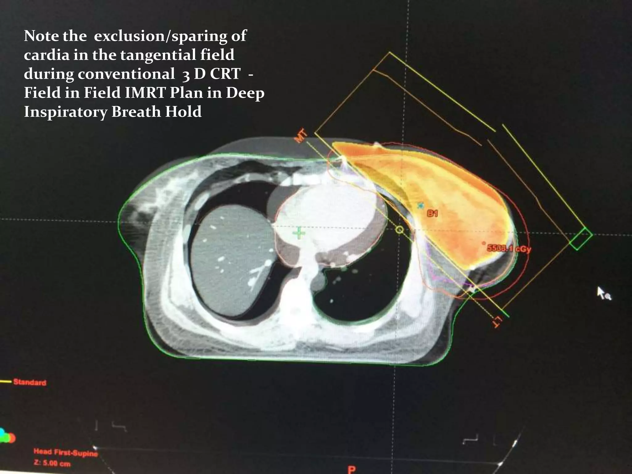 Breast Cancer Radiation Therapy: RT Plan evaluation & Recent Advances ...