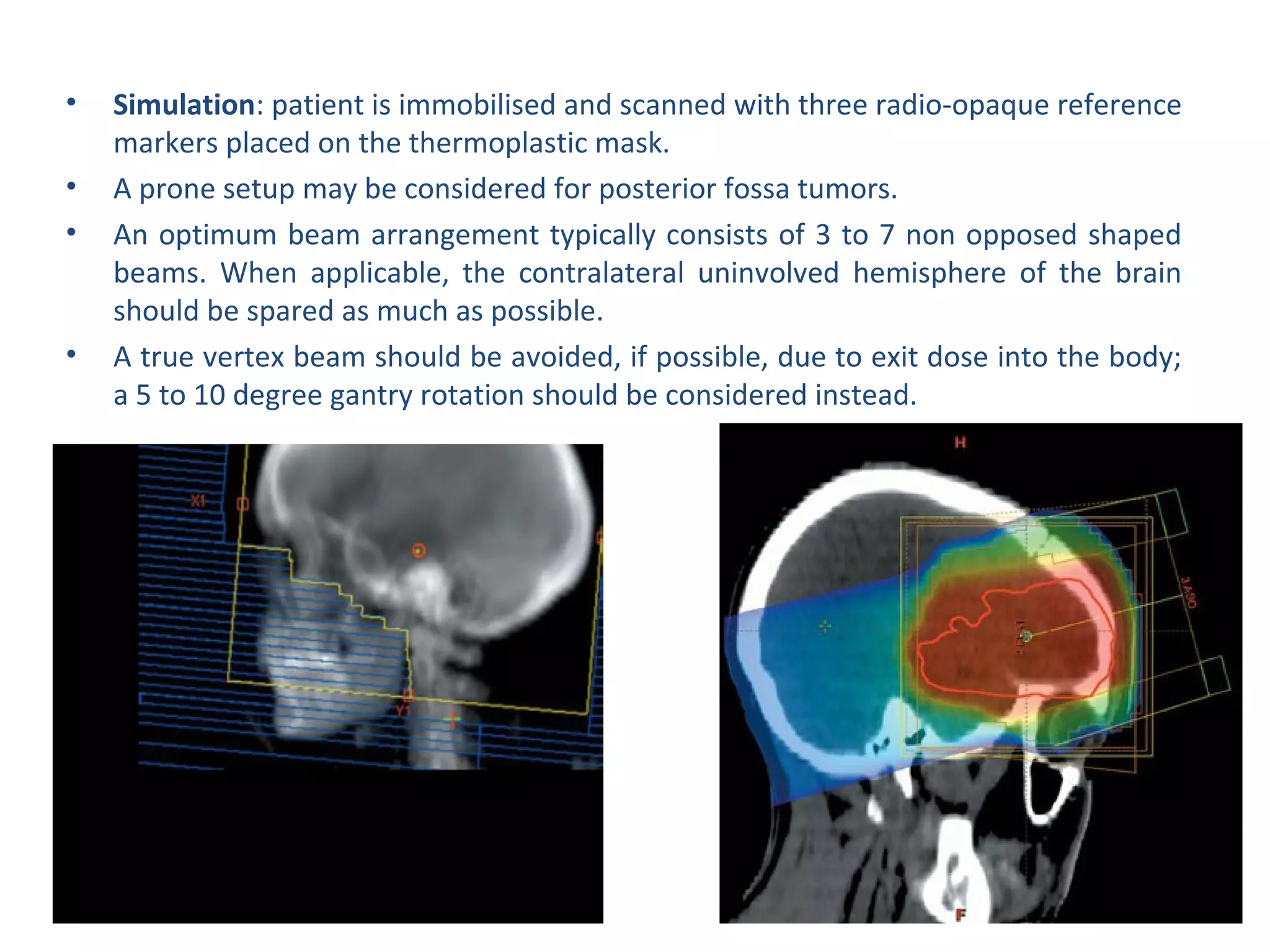 Radiotherapy plan evaluation in brain tumours | PPT