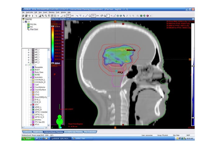 Radiotherapy plan evaluation in brain tumours | PPT | Brain and Nervous ...