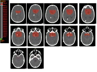 Brain Radiotherapy Card Radiotherapy plan evaluation in brain tumours | PPT