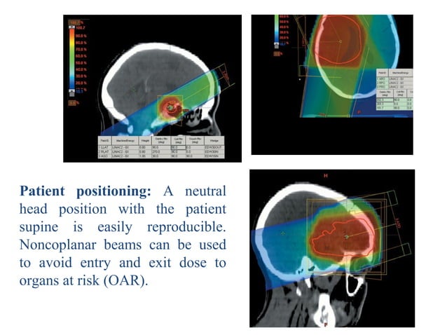 Radiotherapy plan evaluation in brain tumours | PPT | Brain and Nervous ...