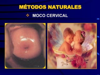 MOCO CERVICAL MÉTODOS NATURALES 