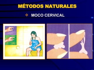 MOCO CERVICAL MÉTODOS NATURALES 