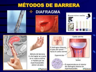 DIAFRAGMA MÉTODOS DE BARRERA 