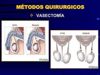 VASECTOMÍA MÉTODOS QUIRURGICOS 