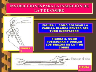 OBSTETRICIA PLANIFICACIÓN FAMILIAR INSTRUCCIONES PARA LA INSERCIÓN DE LA T DE COBRE FIGURA 2. COMO POSICIONAR Y DOBLAR LOS BRAZOS DE LA T DE COBRE   FIGURA 1. COMO COLOCAR LA VARILLA BLANCA DENTRO DEL TUBO INSERTADOR   FIGURA 2  FIGURA 1  