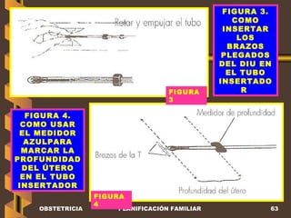 OBSTETRICIA PLANIFICACIÓN FAMILIAR FIGURA 3. COMO INSERTAR LOS BRAZOS PLEGADOS DEL DIU EN EL TUBO INSERTADOR   FIGURA 4. COMO USAR EL MEDIDOR AZULPARA MARCAR LA PROFUNDIDAD DEL ÚTERO  EN EL TUBO INSERTADOR FIGURA 3  FIGURA 4  