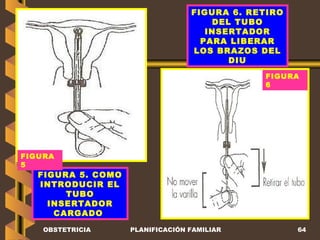 OBSTETRICIA PLANIFICACIÓN FAMILIAR FIGURA 5. COMO INTRODUCIR EL TUBO INSERTADOR CARGADO   FIGURA 6. RETIRO DEL TUBO INSERTADOR PARA LIBERAR LOS BRAZOS DEL DIU FIGURA 6  FIGURA 5  