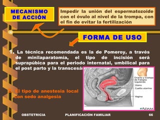 OBSTETRICIA PLANIFICACIÓN FAMILIAR MECANISMO DE ACCIÓN Impedir la unión del espermatozoide con el óvulo al nivel de la trompa, con el fin de evitar la fertilización FORMA DE USO 1.  La técnica recomendada es la de Pomeroy, a través de minilaparatomía, el tipo de incisión será suprapúbica para el periodo internatal, umbilical para el post parto y la transcesárea 2.   El tipo de anestesia local con sedo analgesia  
