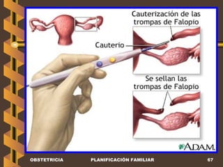 OBSTETRICIA PLANIFICACIÓN FAMILIAR 