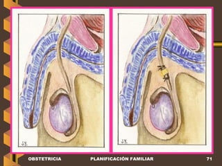 OBSTETRICIA PLANIFICACIÓN FAMILIAR 