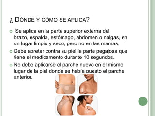 ¿ Dónde y cómo se aplica? Se aplica en la parte superior externa del brazo, espalda, estómago,abdomen o nalgas, en un lugar limpio y seco, pero no en las mamas.Debe apretar contra su piel la parte pegajosa que tiene el medicamento durante 10 segundos.No debe aplicarse el parche nuevo en el mismo lugar de la piel donde se había puesto el parche anterior.