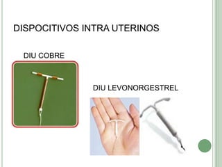DISPOCITIVOS INTRA UTERINOS    DIU COBRE                                       DIU LEVONORGESTREL