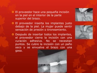  El proveedor hace una pequeña incisión
en la piel en el interior de la parte
superior del brazo.
 El proveedor inserta los implantes justo
debajo de la piel. La mujer puede sentir
sensación de presión o tironeamiento.
 Después de insertar todos los implantes,
el proveedor cierra la incisión con una
curación adhesiva. No se necesitan
puntos. Se cubre la incisión con un paño
seco y se envuelve el brazo con una
gasa.
 