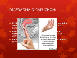 DIAFRAGMA O CAPUCHON:
 El diafragma se coloca profundamente en la vagina
antes del sexo. Cubre el cérvix. Los espermicidas
brindan protección anticonceptiva adicional.
 Antes de comenzar a utilizarlo se requiere un
examen pélvico. El proveedor debe seleccionar un
diafragma que se ajuste adecuadamente.
 Para obtener la mayor eficacia se requiere un uso
correcto en cada acto sexual.
 