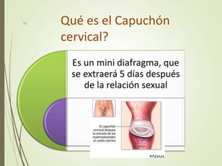 Qué es el Capuchón
cervical?
16
 