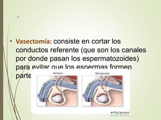 • Vasectomía: consiste en cortar los
conductos referente (que son los canales
por donde pasan los espermatozoides)
para evitar que los espermas formen
parte del semen.
26
 