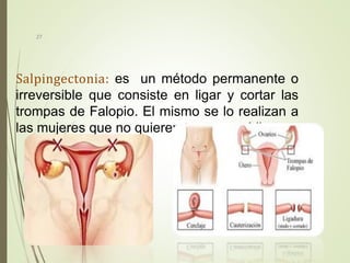 Salpingectonia: es un método permanente o
irreversible que consiste en ligar y cortar las
trompas de Falopio. El mismo se lo realizan a
las mujeres que no quieren tener mas hijos.
27
 