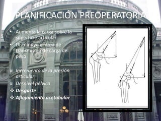 PLANIFICACIÓN PREOPERATORIA 
• Aumenta la carga sobre la 
superficie articular 
• Disminuye el área de 
transmisión de carga del 
peso 
α Incremento de la presión 
articular 
α Desnivel pélvico 
 Desgaste 
 Aflojamiento acetabular 
 