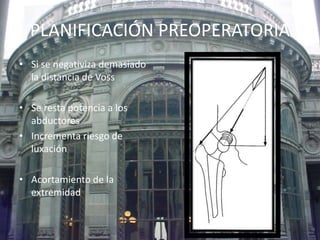 PLANIFICACIÓN PREOPERATORIA 
• Si se negativiza demasiado 
la distancia de Voss 
• Se resta potencia a los 
abductores 
• Incrementa riesgo de 
luxación 
• Acortamiento de la 
extremidad 
 