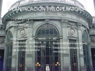 PLANIFICACIÓN PREOPERATORIA 
ESTABILIDAD DEL ACETÁBULO 
ORIENTACIÓN 
Inclinación del techo 
acetabular establece la 
contención o expulsión 
de la cabeza femoral 
• 40° 
• Reducción transoperatoria 
• Estabilidad biológica y 
mecánica. 
 