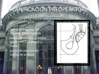 PLANIFICACIÓN PREOPERATORIA 
• SELECCIÓN DEL PACIENTE 
• Forma geométrica del 
endostio y del implante 
• Radios de curvatura medial 
iguales entre implante y 
hueso 
• centro de rotación de 
cabeza de prótesis 
 
