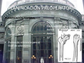 PLANIFICACIÓN PREOPERATORIA 
PLANIFICACIÓN FEMORAL 
• Sujeto idóneo 
• Tamaño de la prótesis 
• Puntos de referencia para el 
nivel de osteotomía 
• Punta de trocánter mayor 
• Parte superior de trocánter 
menor 
• Ambos 
• 50° 
 