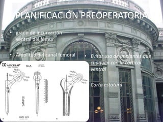 PLANIFICACIÓN PREOPERATORIA 
• grado de incurvación 
ventral del fémur 
• Amplitud del canal femoral • Evitar uso de implantes que 
choquen con la cortical 
ventral 
• Corta estatura 
 