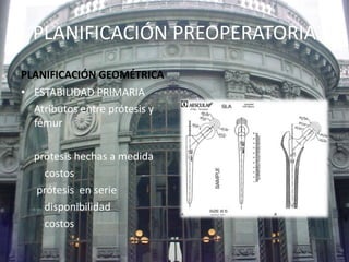 PLANIFICACIÓN PREOPERATORIA 
PLANIFICACIÓN GEOMÉTRICA 
• ESTABILIDAD PRIMARIA 
Atributos entre prótesis y 
fémur 
prótesis hechas a medida 
costos 
prótesis en serie 
disponibilidad 
costos 
 