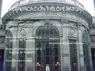 PLANIFICACIÓN PREOPERATORIA 
ATRIBUTOS ANATÓMICOS 
• PLANO ANTEROPOSTERIOR 
Distancia de Voss 
Brazo de palanca largo de la 
balanza de Pauwells 
Brazo de palanca corto de la 
balanza de Pauwells 
Posición vara o valga 
• PLANO LATERAL 
Anteversión 
Amplitud de canal medular 
 