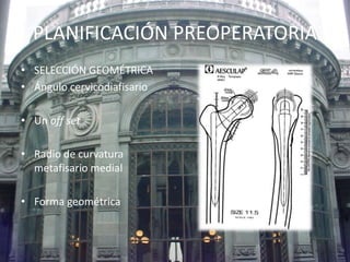 PLANIFICACIÓN PREOPERATORIA 
• SELECCIÓN GEOMÉTRICA 
• Ángulo cervicodiafisario 
• Un off set 
• Radio de curvatura 
metafisario medial 
• Forma geométrica 
 