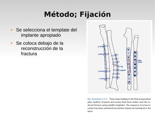 Método; Fijación
 Se selecciona el template del
implante apropiado
 Se coloca debajo de la
reconstrucción de la
fractura
 