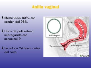 Anillo vaginal Efectividad: 80%, con condón del 98% Disco de poliuretano impregnado con nonoxinol-9 Se coloca 24 horas antes del coito 