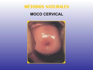 MOCO CERVICAL MÉTODOS NATURALES 