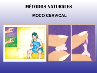 MOCO CERVICAL MÉTODOS NATURALES 
