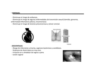 - VENTAJAS:

 - Disminuye el riesgo de embarazo.
 - Disminuye el riesgo de algunas enfermedades de transmisión sexual (clamidia, gonorrea,
enfermedad inflamatoria pélvica, tricomoniasis)
 - Disminuye el riesgo de lesiones precancerosas y cáncer cervical.




- DESVENTAJAS:
  - Riesgo de infecciones urinarias, vaginosis bacteriana y candidiasis.
  - Síndrome de shock tóxico es muy raro.
  - Irritación en o alrededor de vagina o pene
  - Lesión vaginal
 