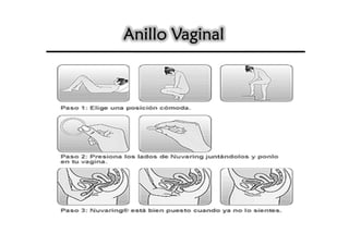 Anillo Vaginal
 